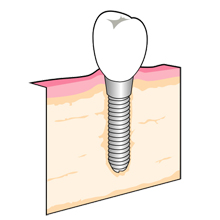 インプラント