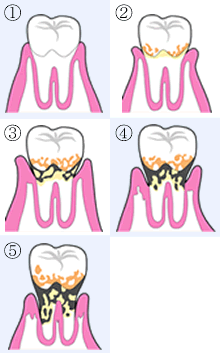 歯周病